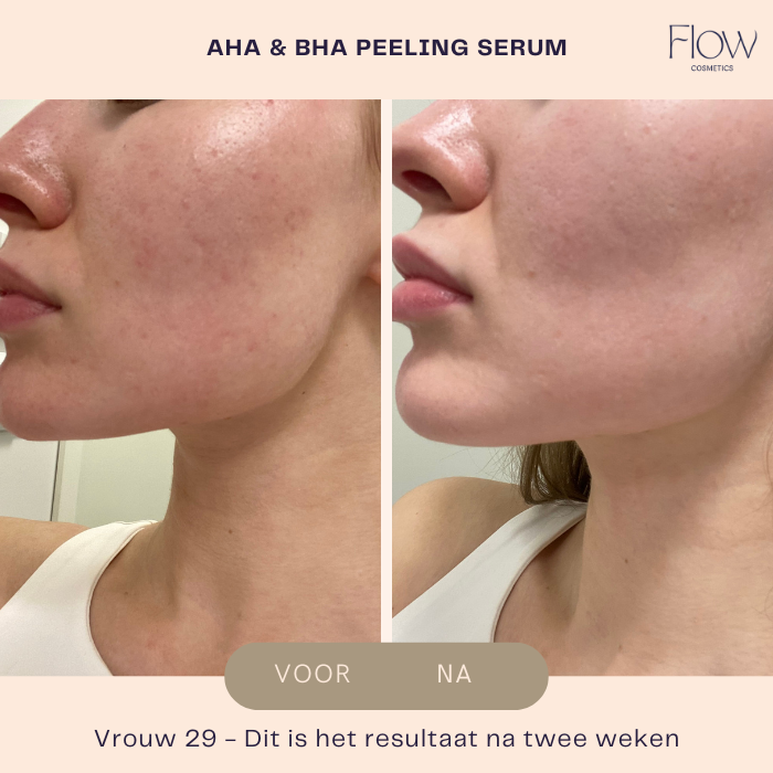 AHA & BHA Peeling Serum - Peeling gezicht - Flow Cosmetics - 30ml